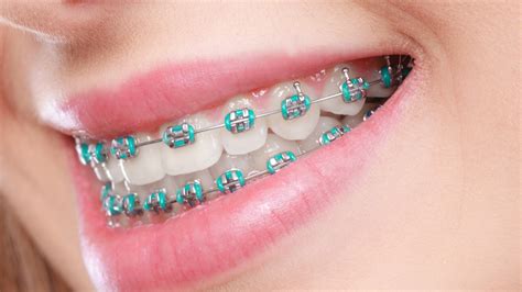 metal bracket orthodontic prices|stainless steel orthodontic braces.